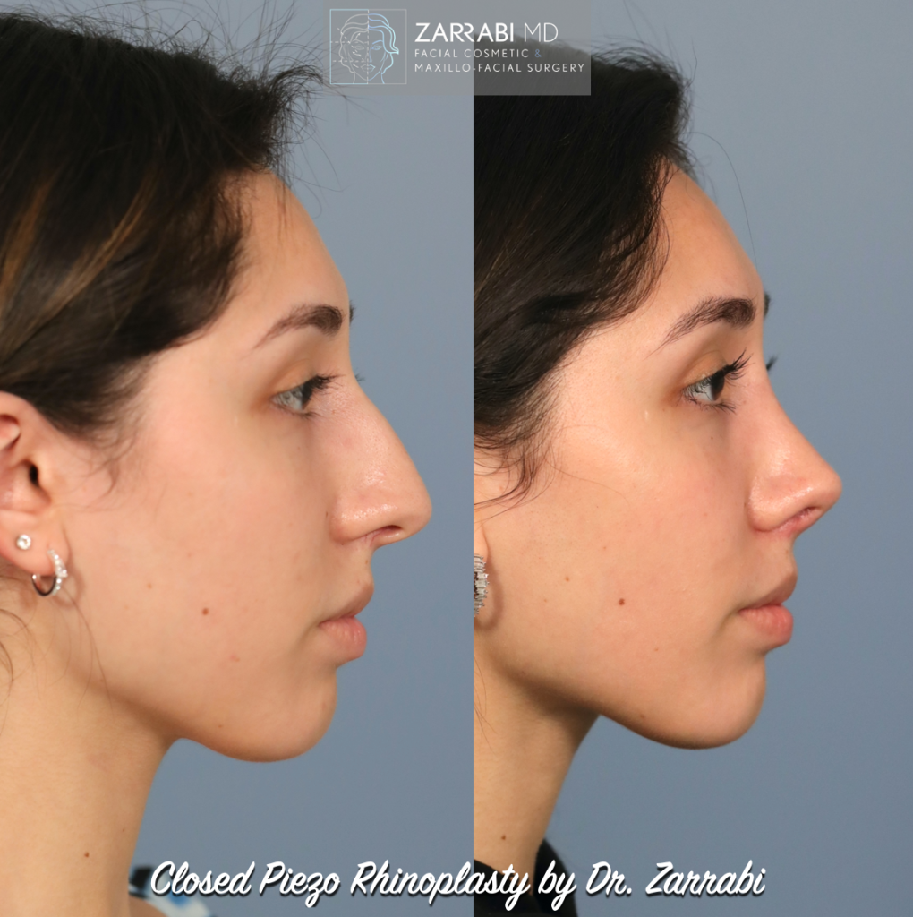 Closed Piezo Rhinoplasty 6 2