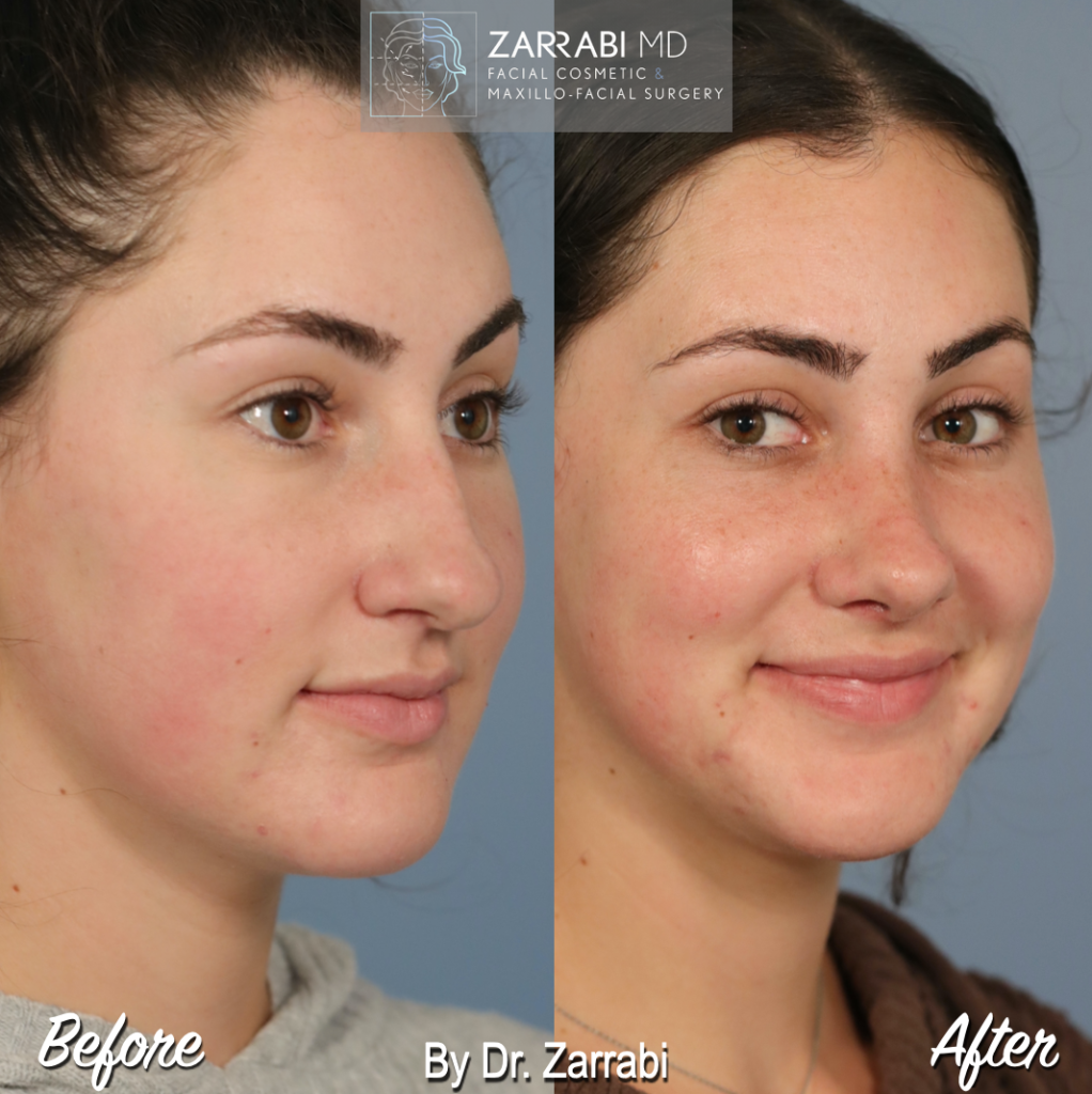 Closed Piezo Rhinoplasty 6 4