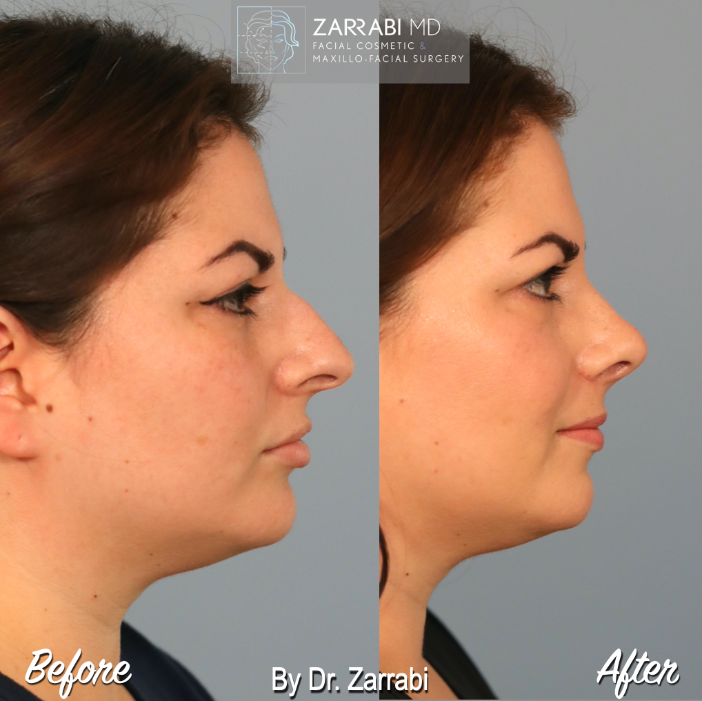 Closed Piezo Rhinoplasty 6 5