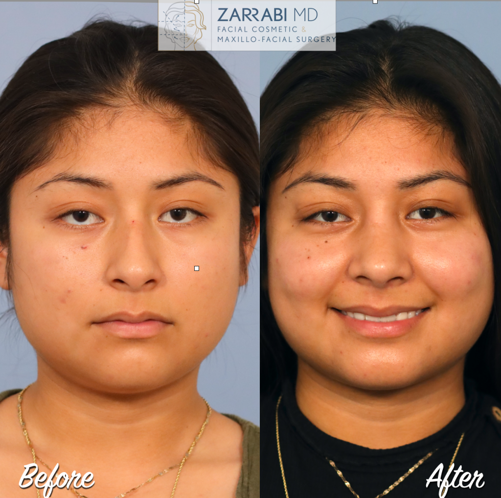 Closed Piezo Rhinoplasty 6 6