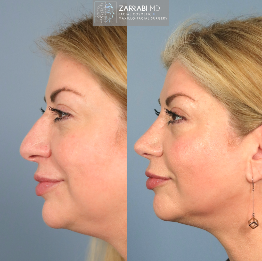 Closed Piezo Rhinoplasty 6