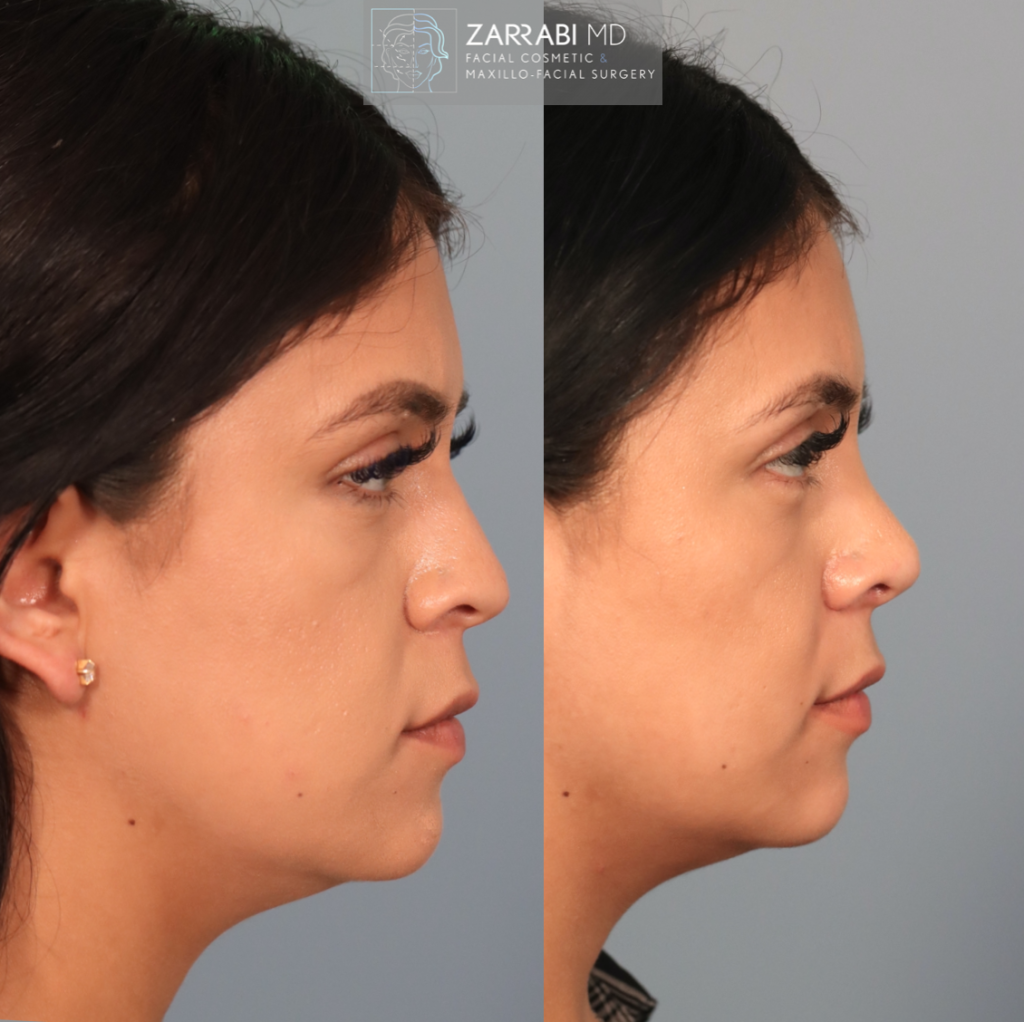Closed Piezo Rhinoplasty 7