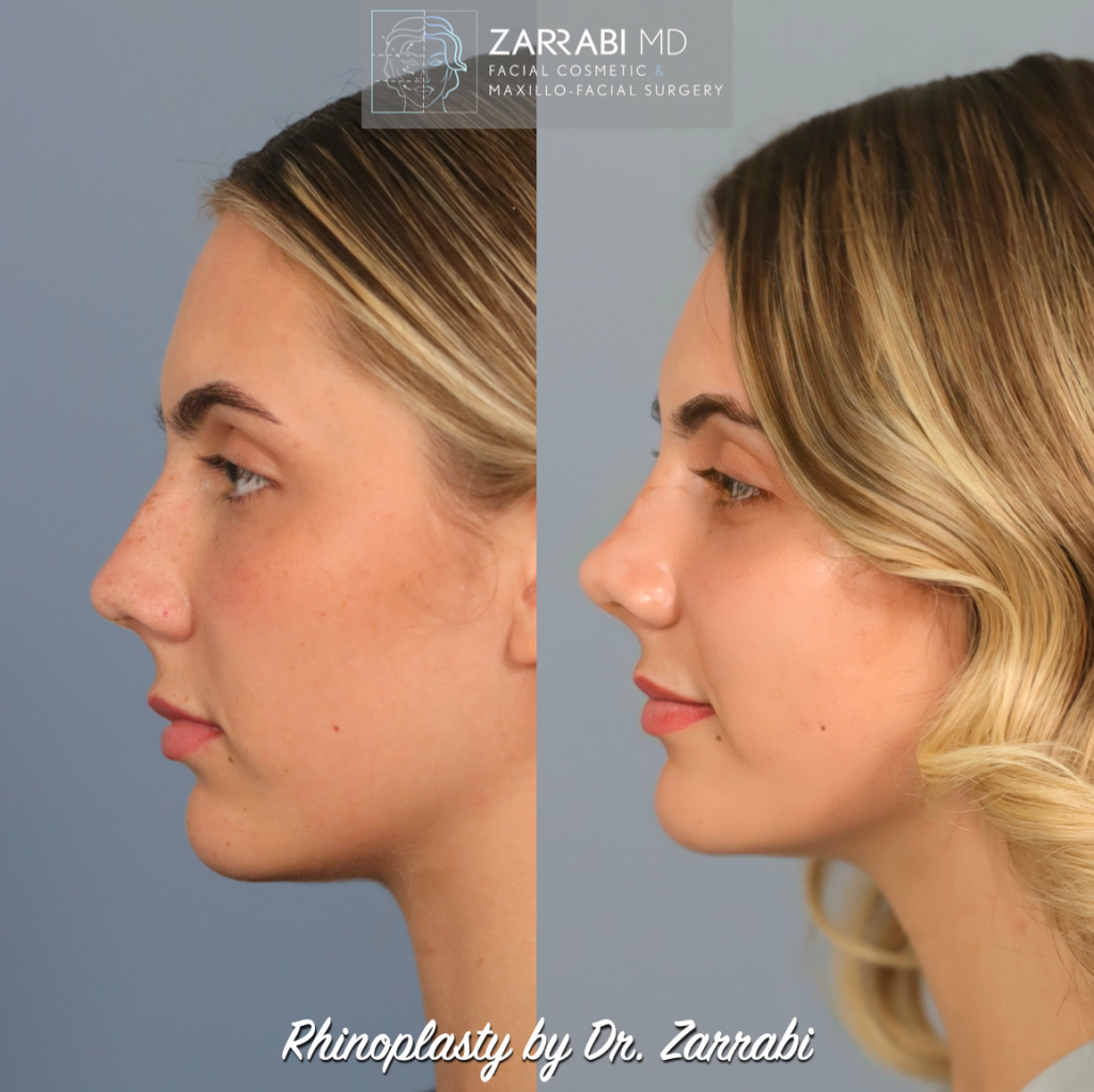 Closed Piezo Rhinoplasty 8