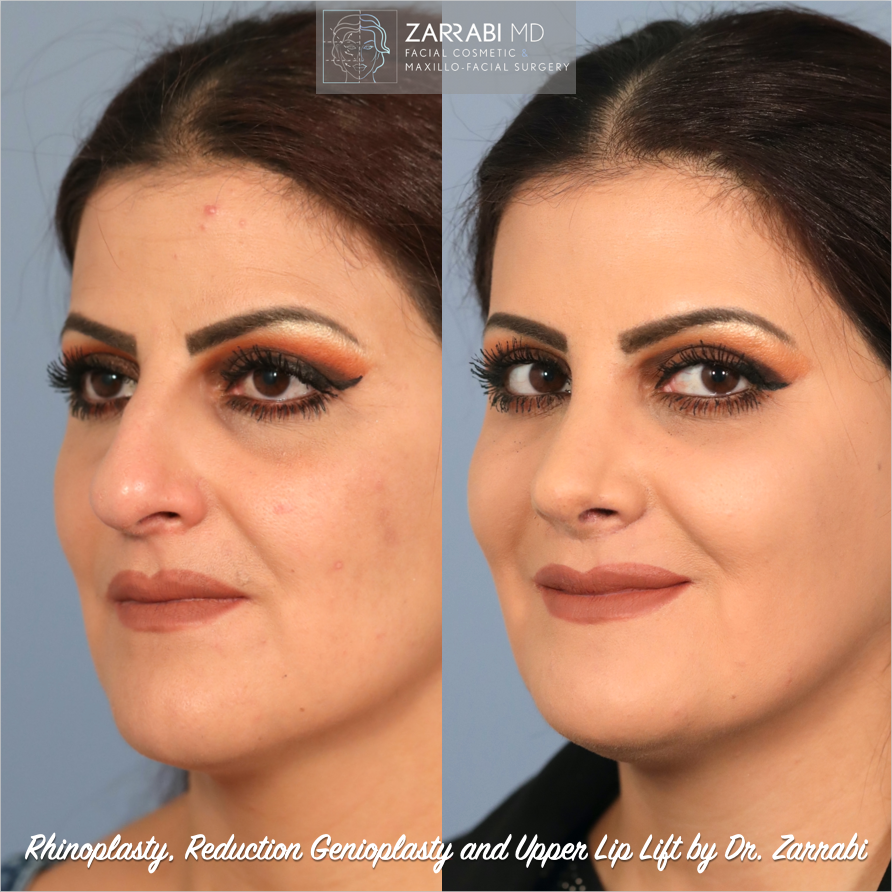 Closed Piezo Rhinoplasty Reduction Genioplasty 1