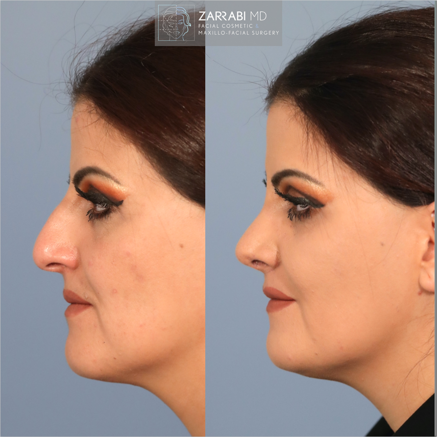 Closed Piezo Rhinoplasty Reduction Genioplasty 2
