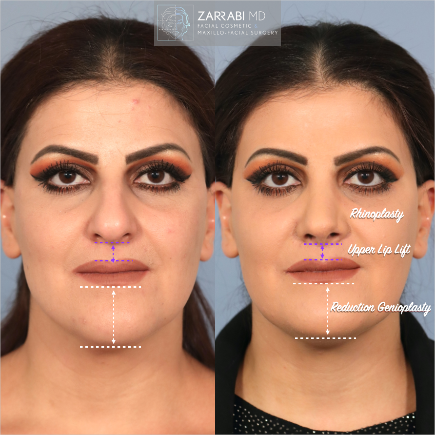 Closed Piezo Rhinoplasty Reduction Genioplasty 3