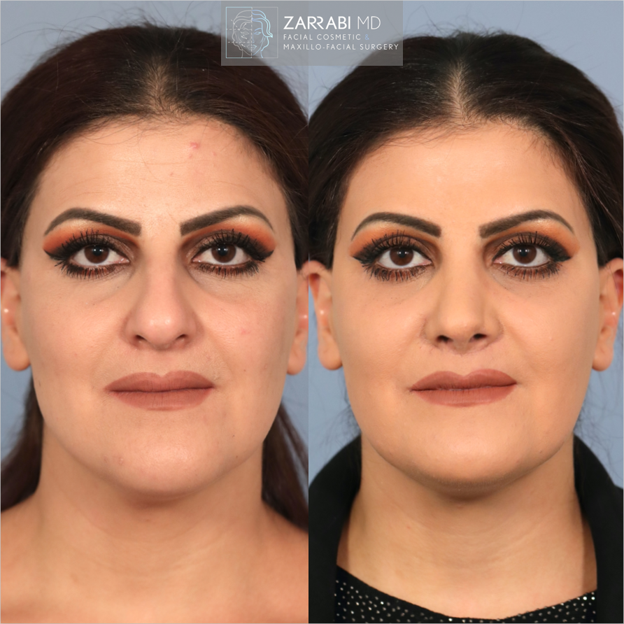 Closed Piezo Rhinoplasty Reduction Genioplasty 4