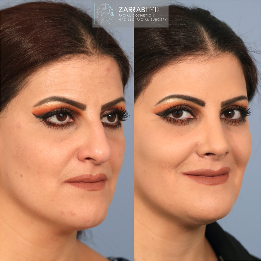 Closed Piezo Rhinoplasty Reduction Genioplasty 5