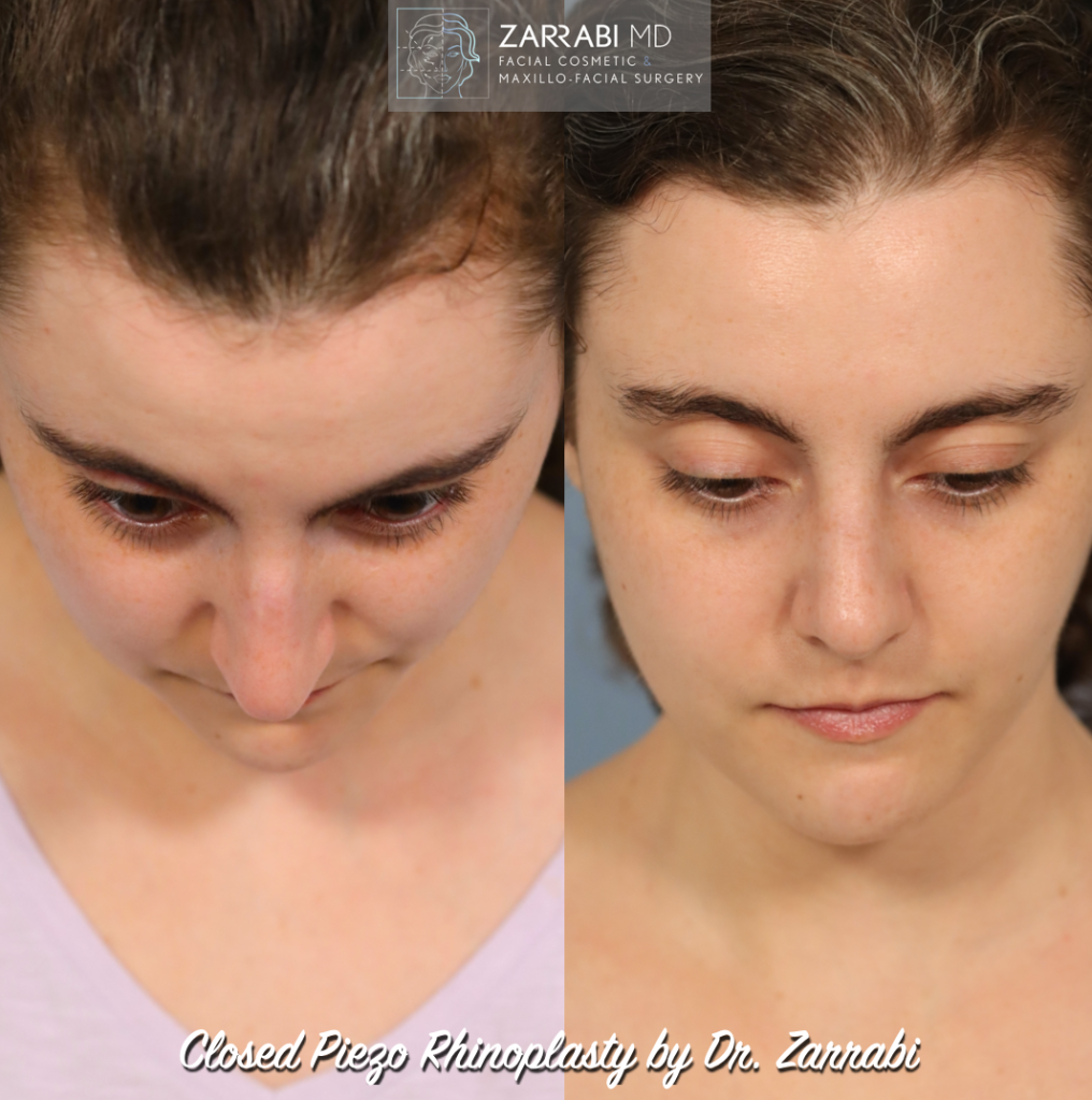 Closed Piezo Ultrasonic Rhinoplasty 1 1