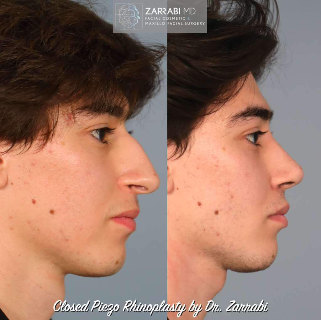 Closed Piezo Ultrasonic Rhinoplasty 1