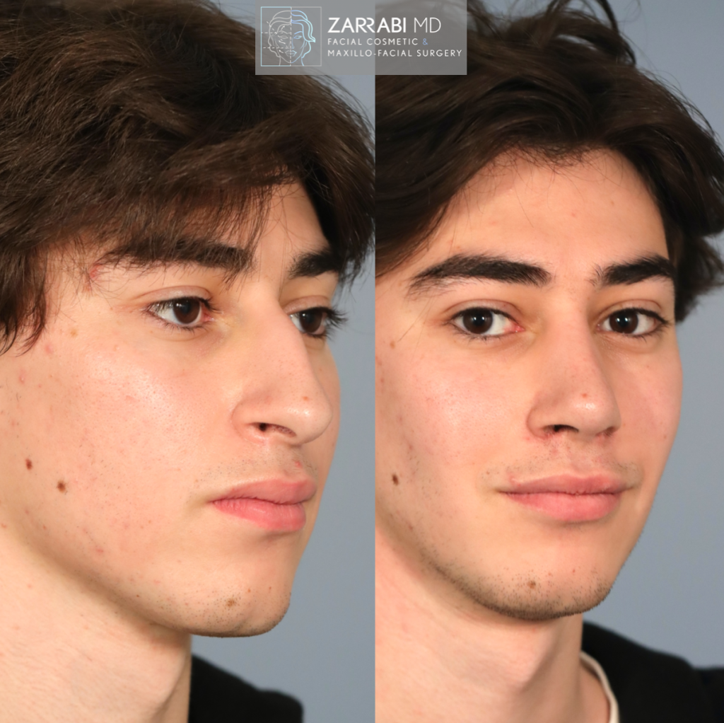 Closed Piezo Ultrasonic Rhinoplasty 2