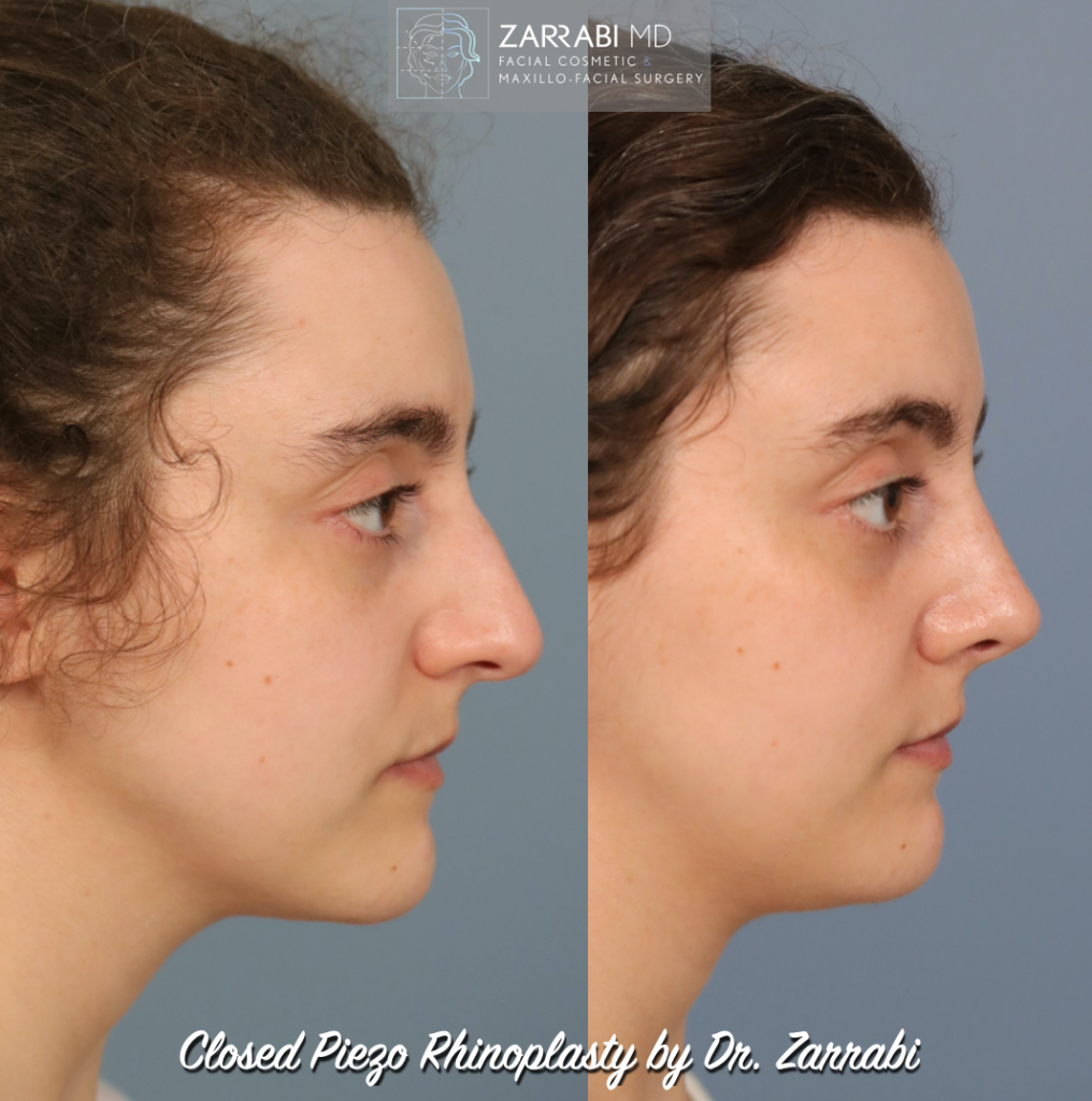 Closed Piezo Ultrasonic Rhinoplasty 3 1