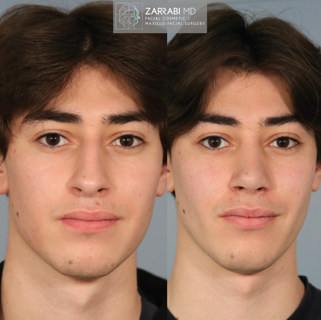 Closed Piezo Ultrasonic Rhinoplasty 3