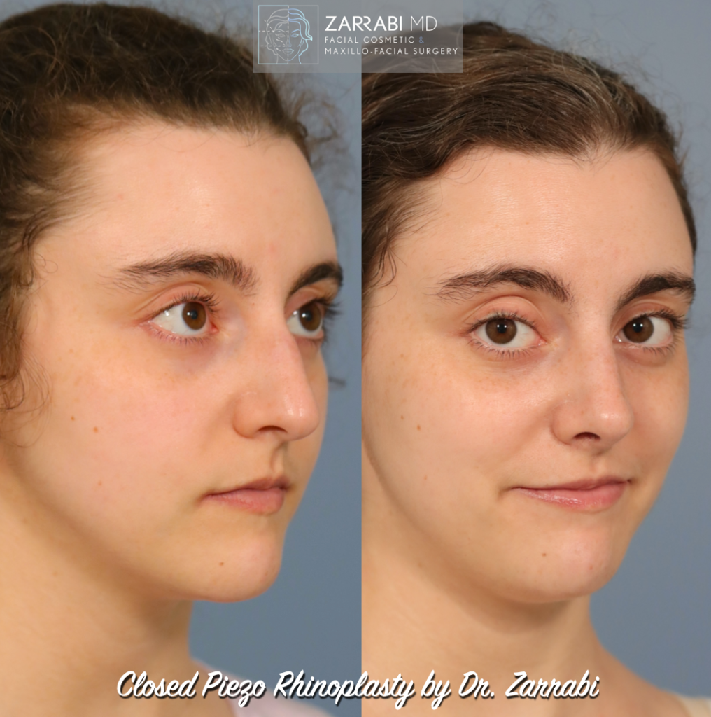 Closed Piezo Ultrasonic Rhinoplasty 4 1