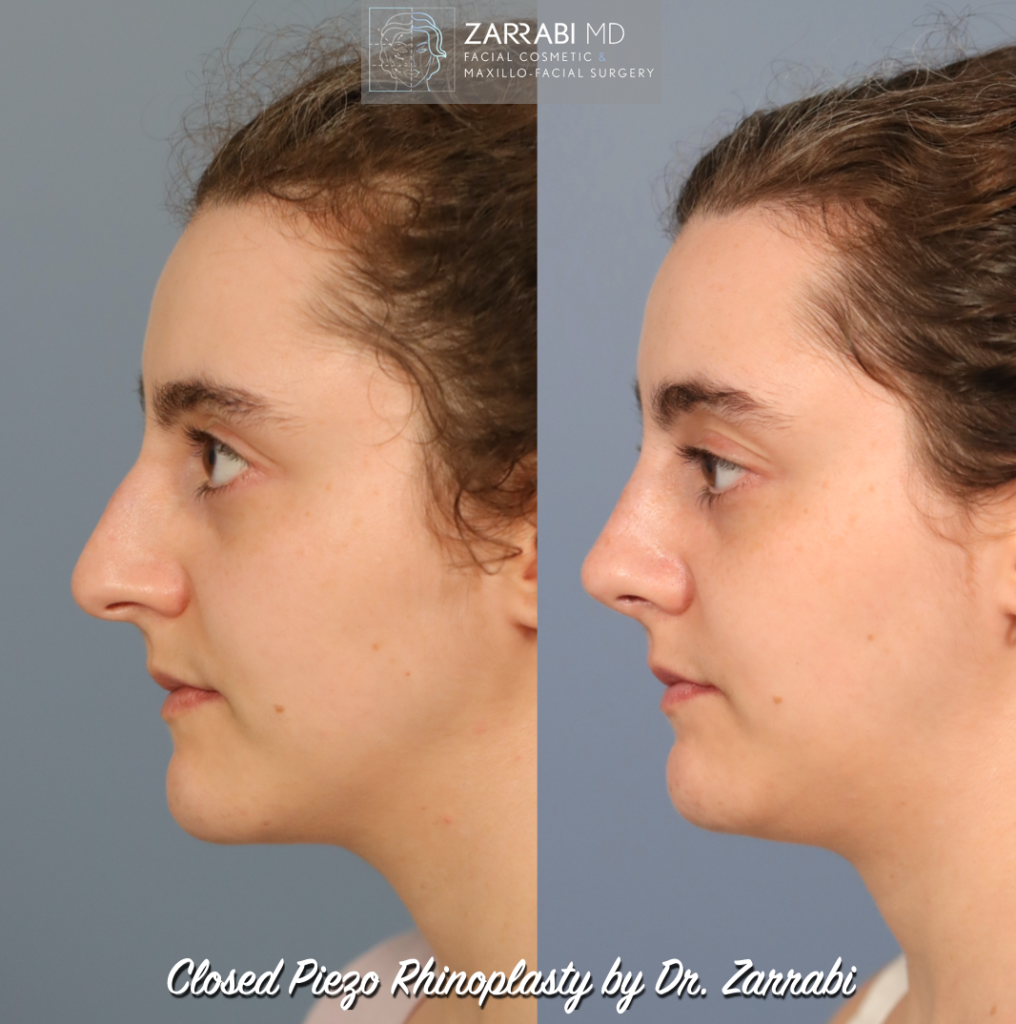 Closed Piezo Ultrasonic Rhinoplasty 5 1
