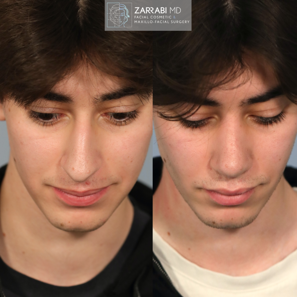 Closed Piezo Ultrasonic Rhinoplasty 5