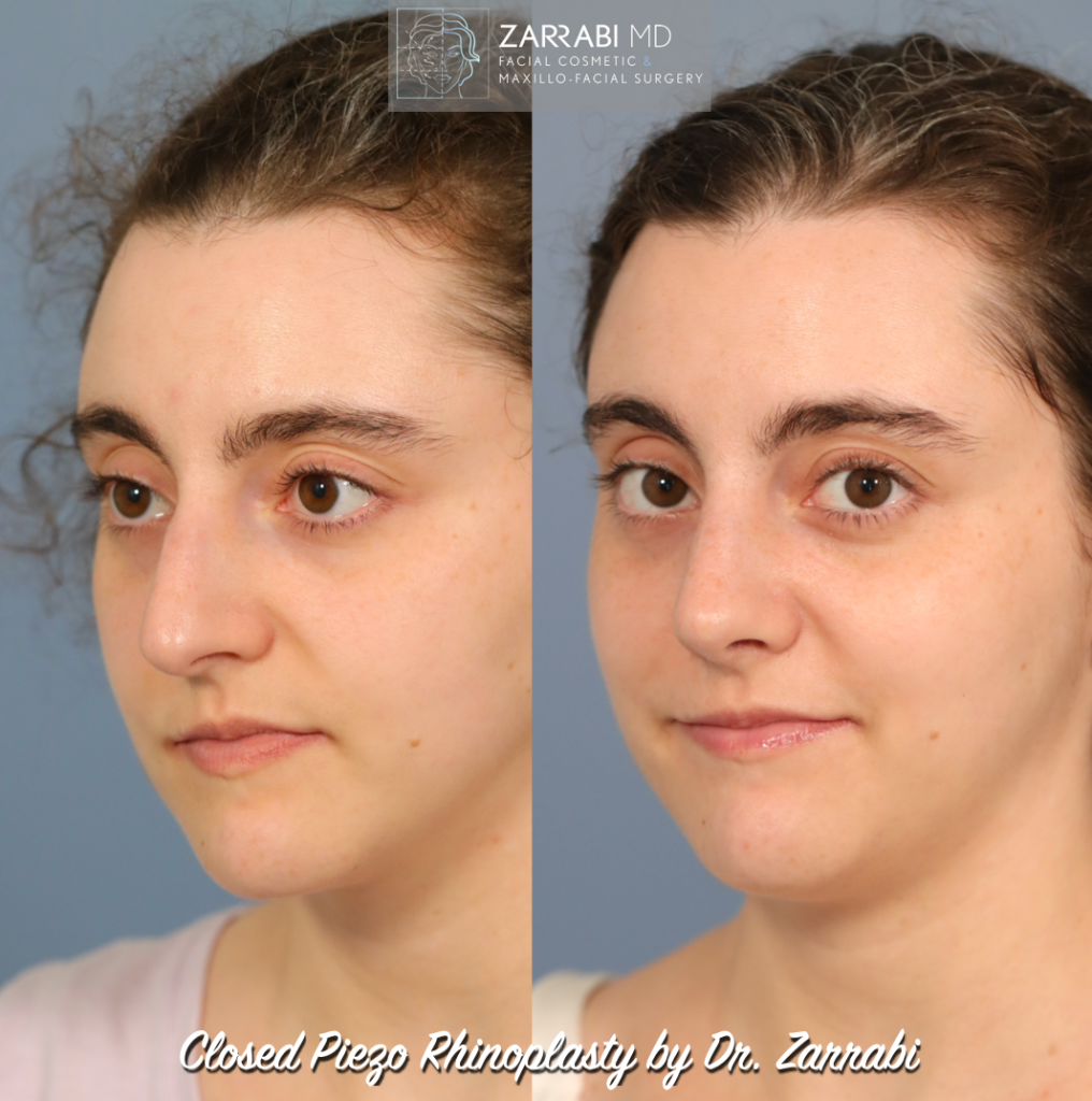 Closed Piezo Ultrasonic Rhinoplasty 6 1