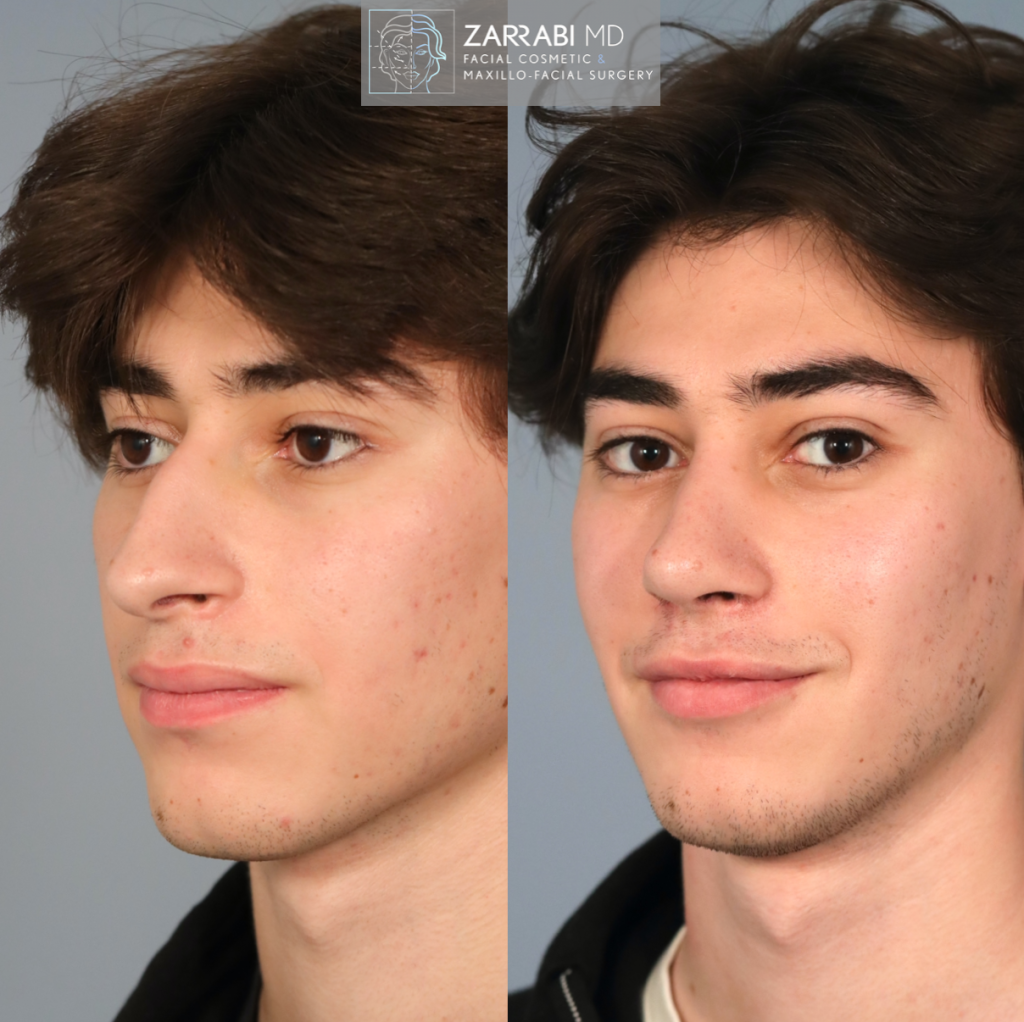 Closed Piezo Ultrasonic Rhinoplasty 6