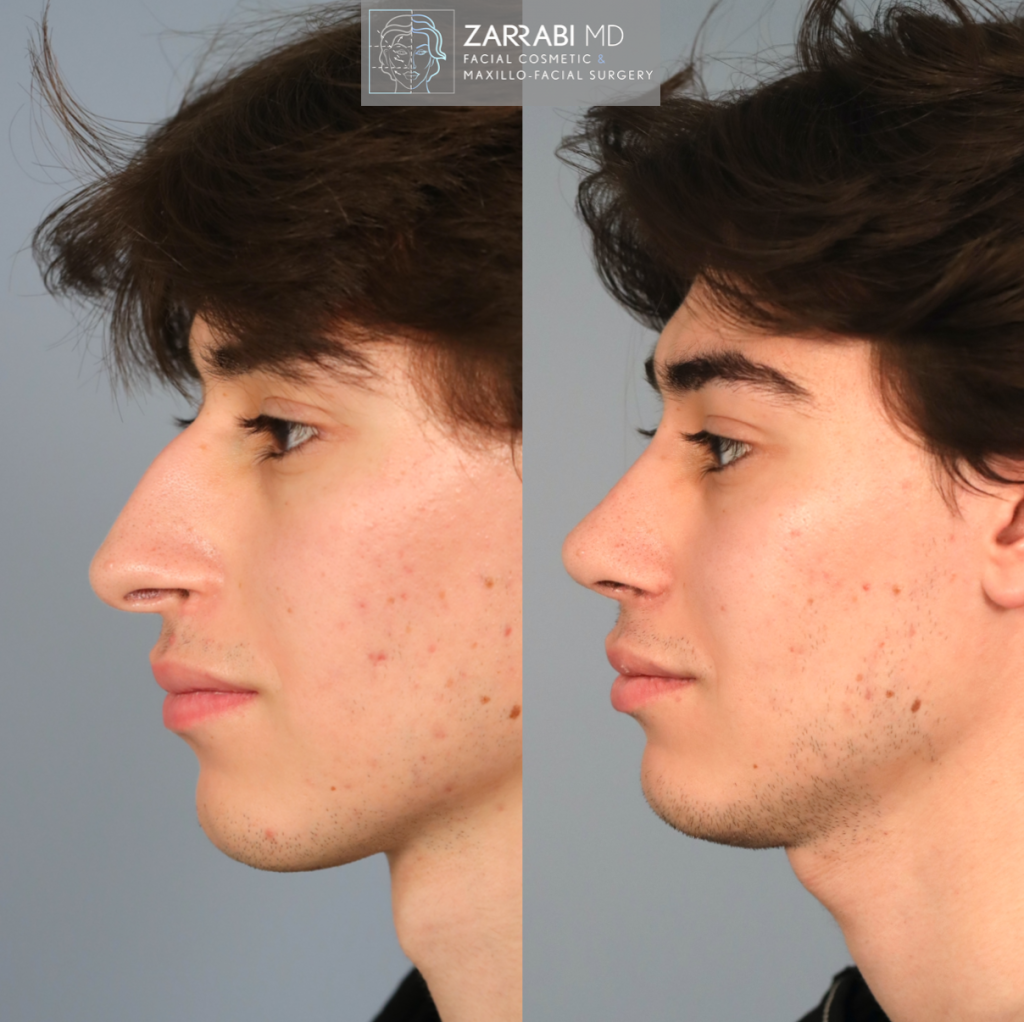 Closed Piezo Ultrasonic Rhinoplasty 7