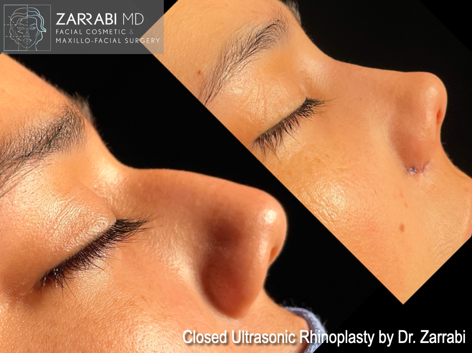 Closed Piezo Ultrasonic Rhinoplasty 8