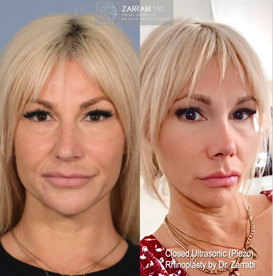 Closed Piezo Ultrasonic Rhinoplasty