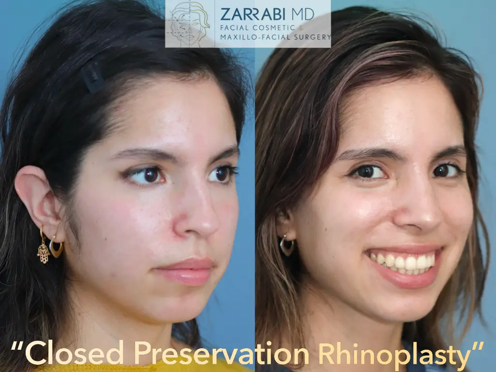 Closed-Preservation-Rhinoplasty-1