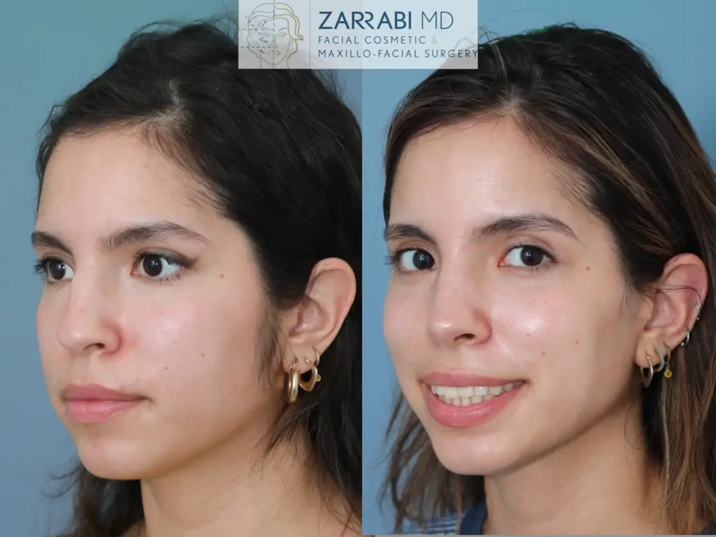 Closed-Preservation-Rhinoplasty-3