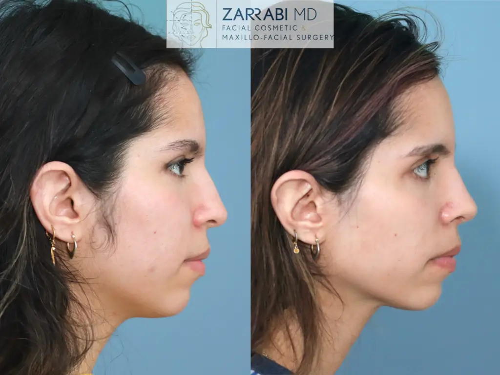 Closed-Preservation-Rhinoplasty-4