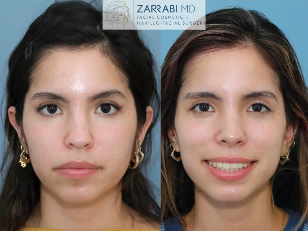 Closed-Preservation-Rhinoplasty-5