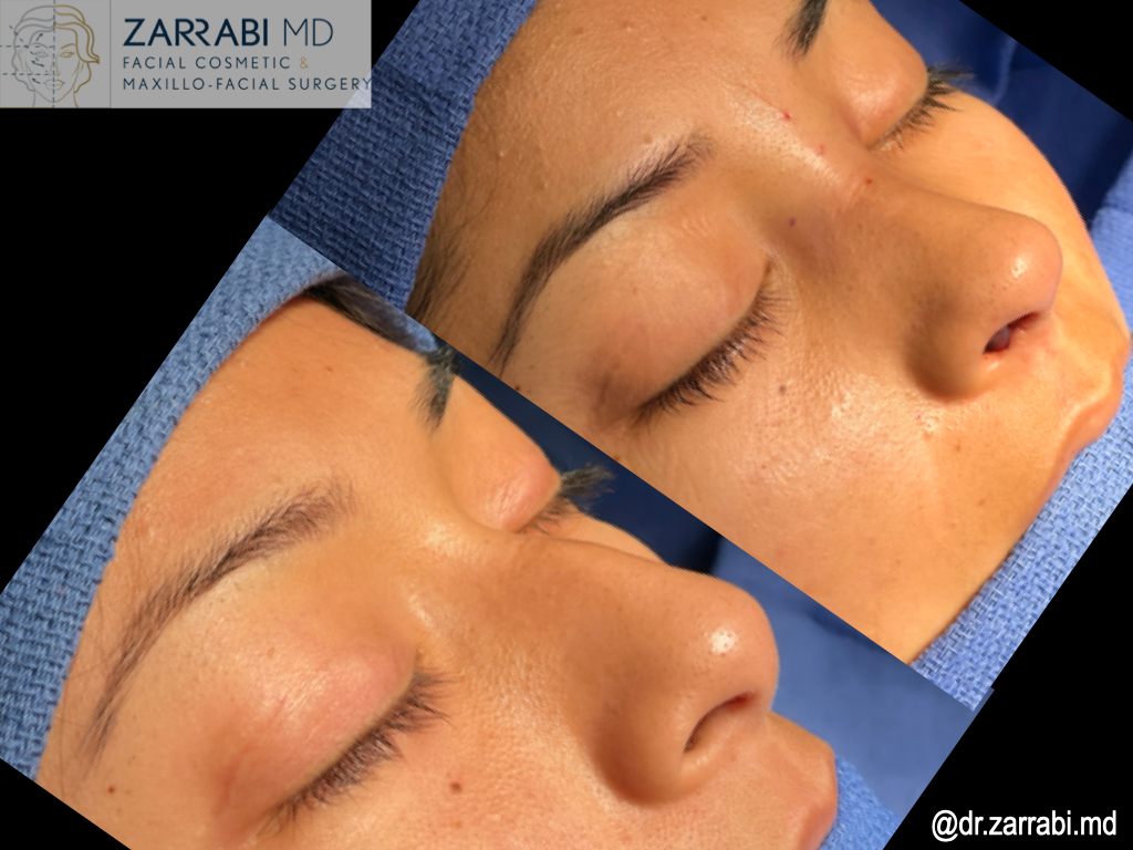 Closed Rhinoplasty Before After 1 1