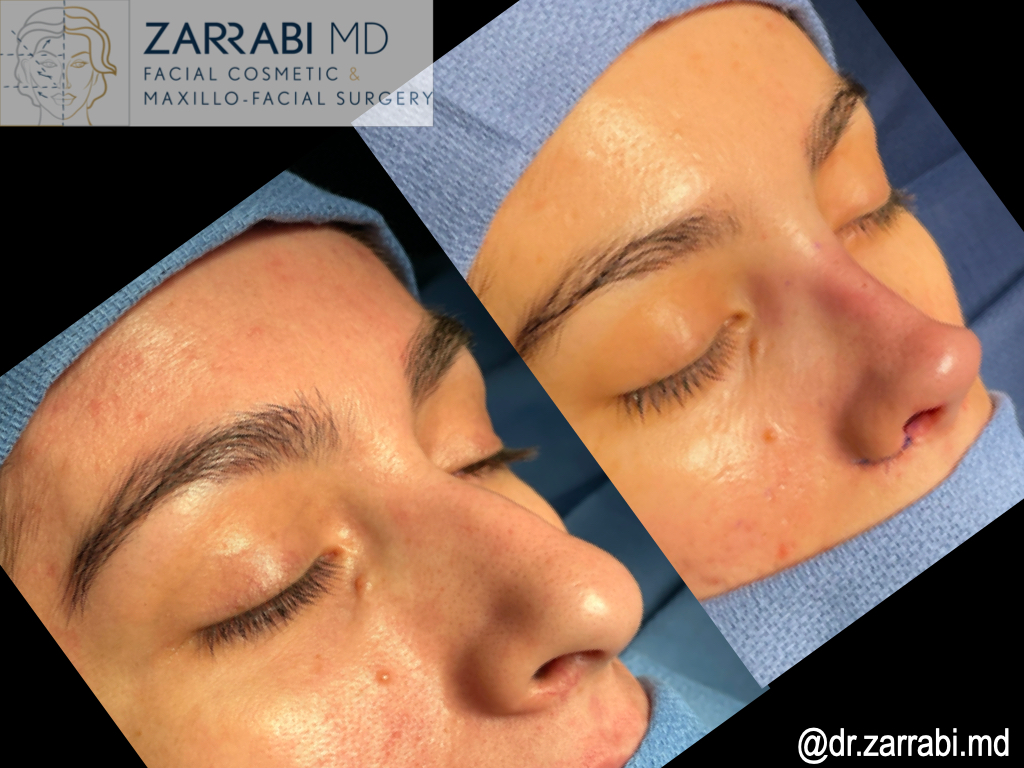 Closed Rhinoplasty Before After 1