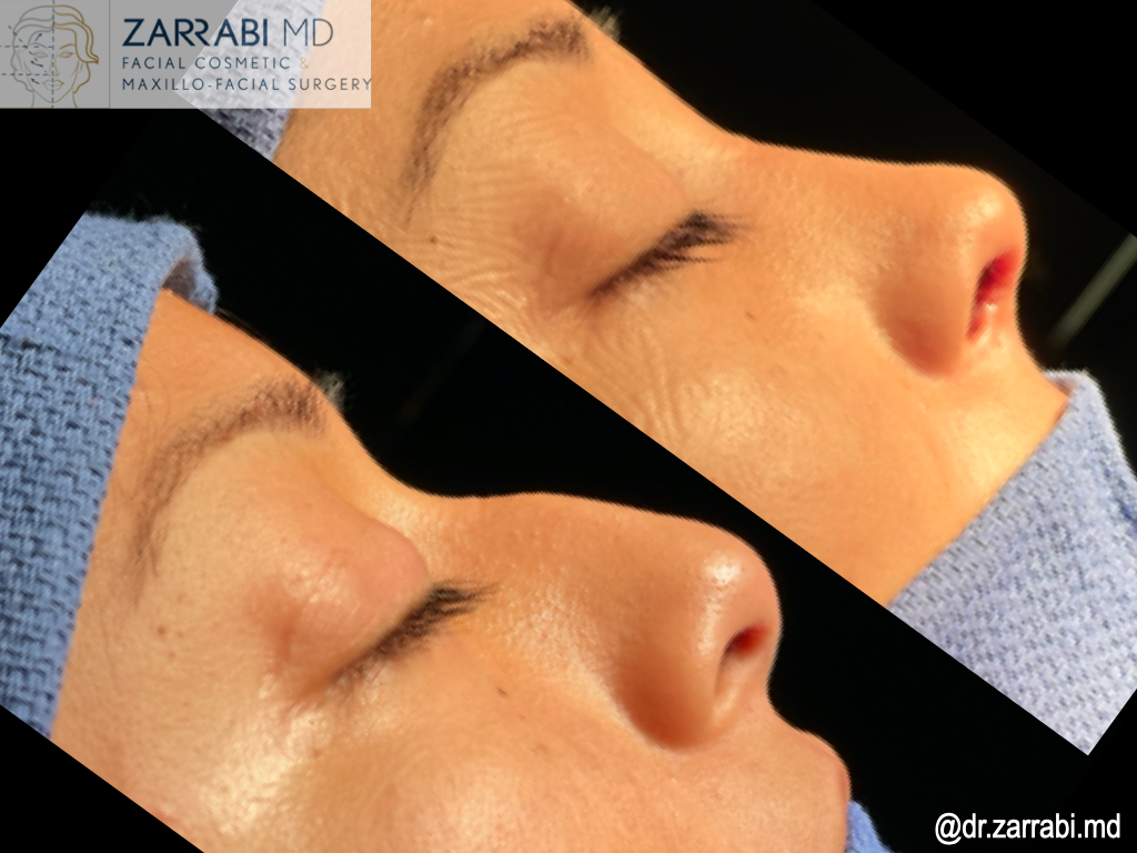 Closed Rhinoplasty Before After 2 1