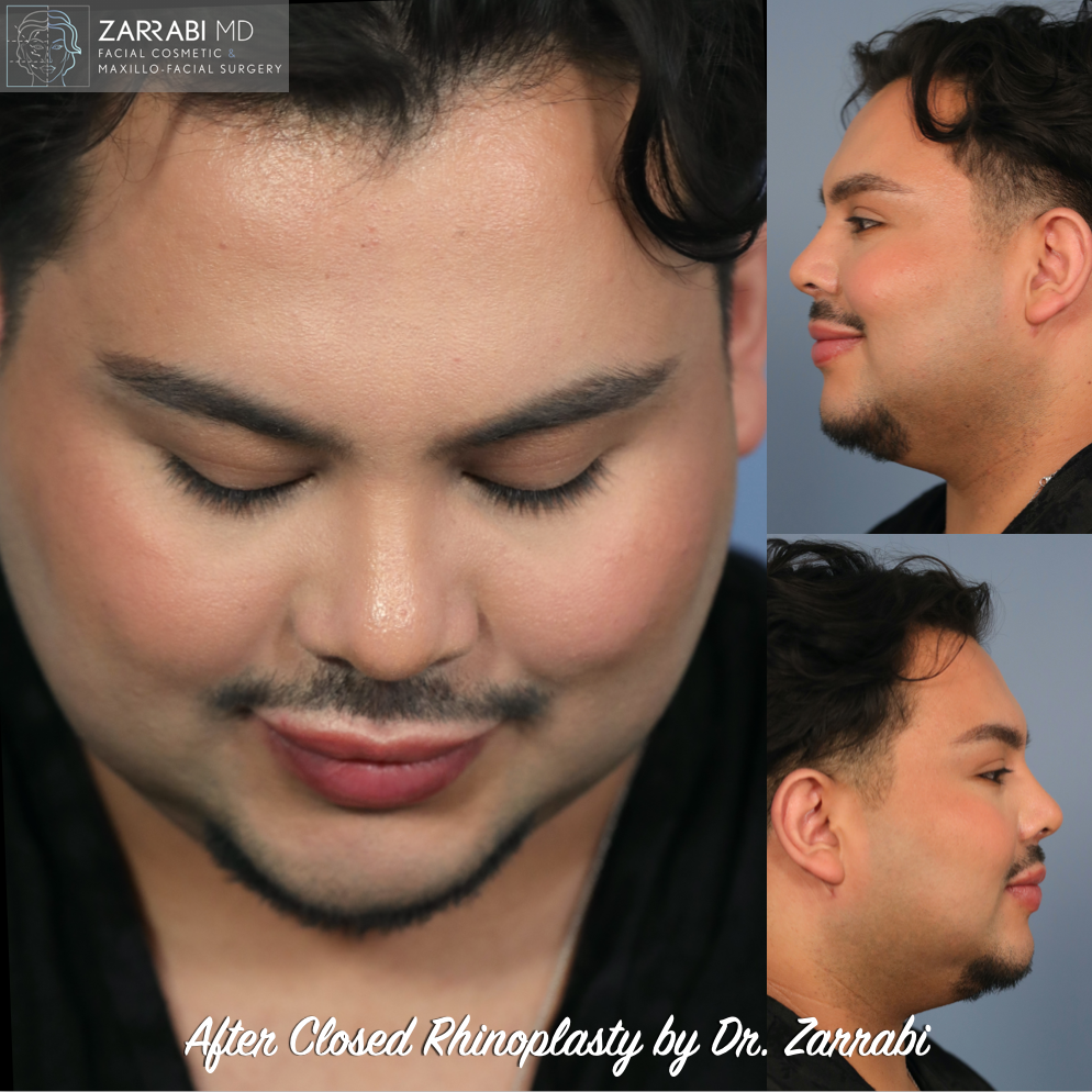 Closed Ultrasonic Piezo Rhinoplasty 1