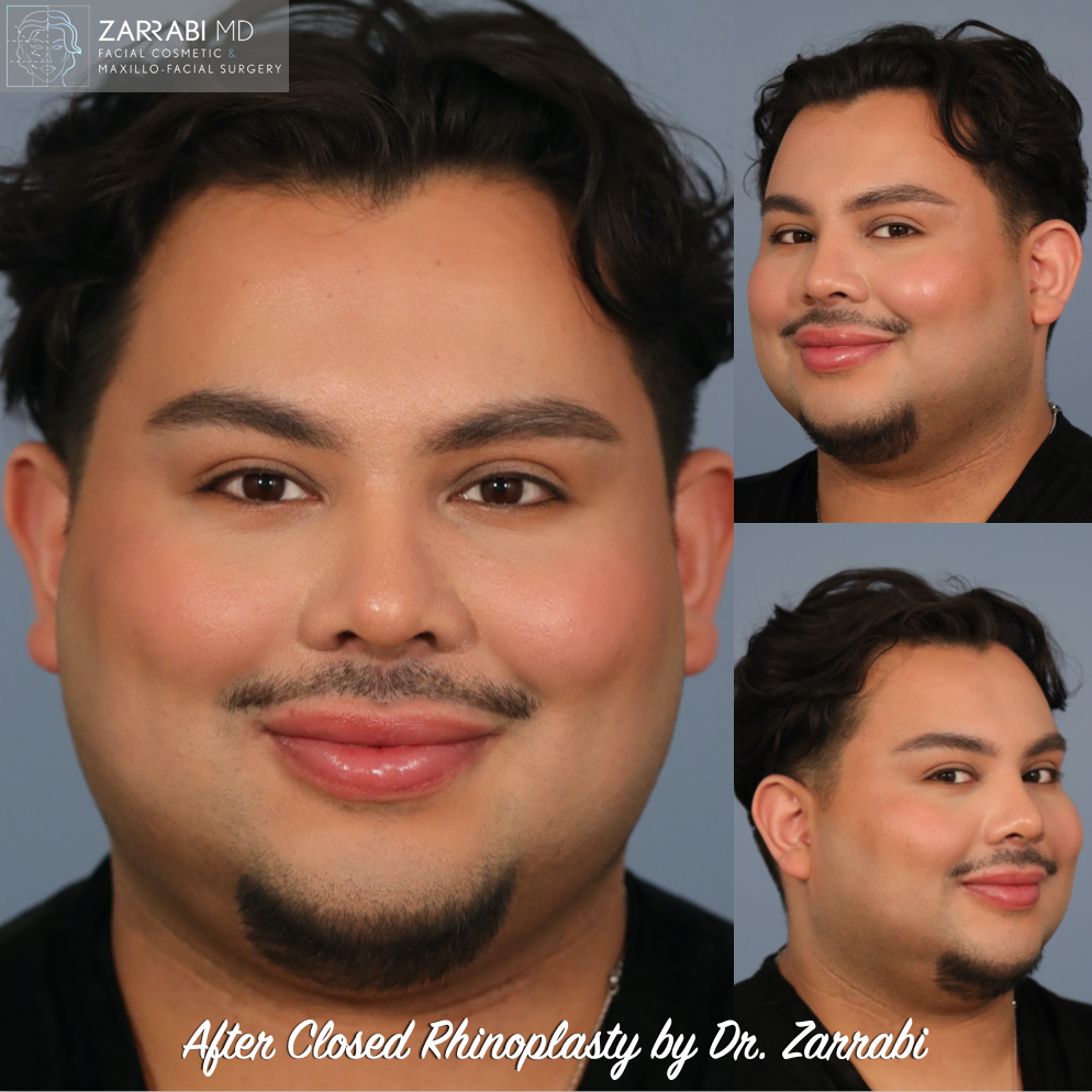 Closed Ultrasonic Piezo Rhinoplasty 2