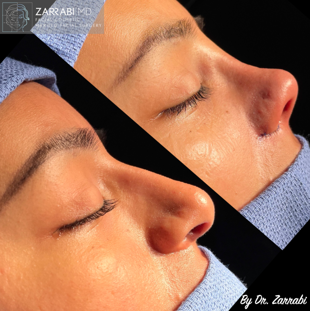 Closed Ultrasonic Rhinoplasty