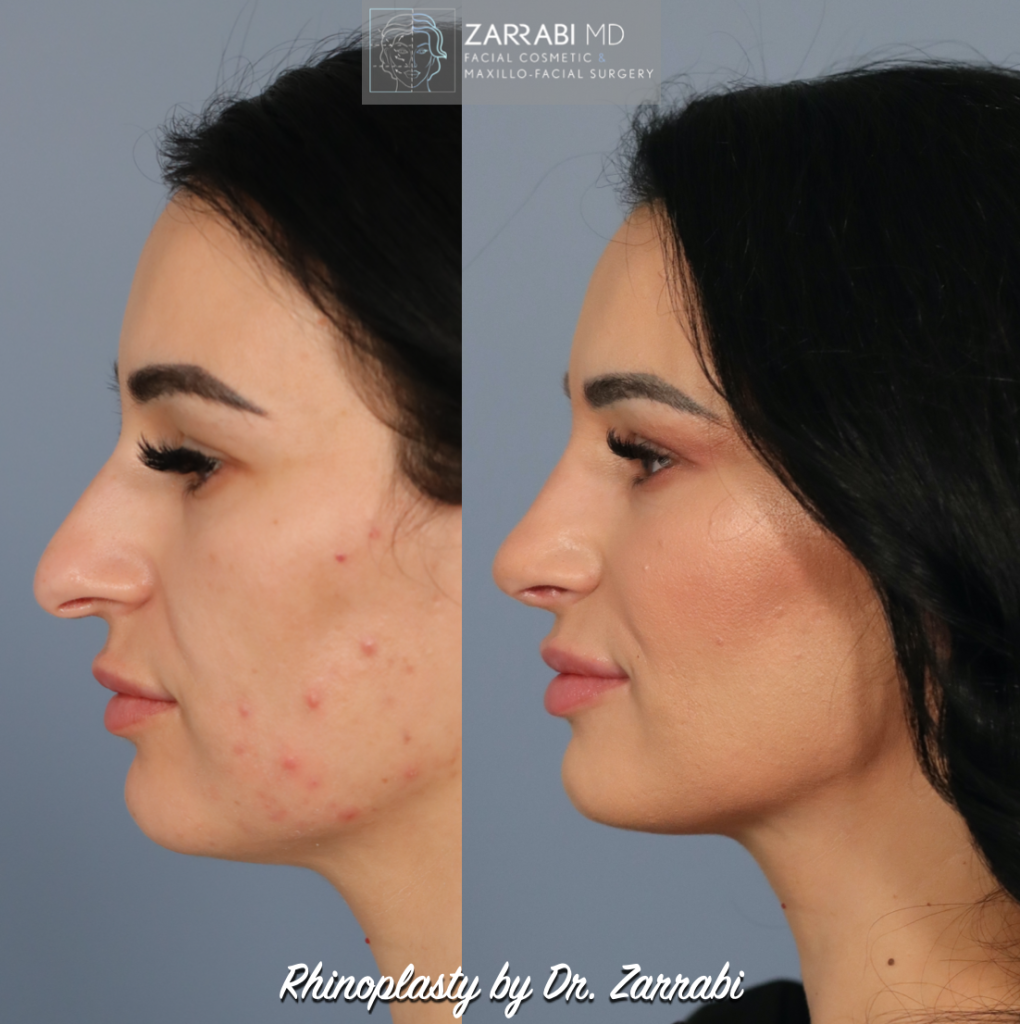 Closed Ultrasonic Rhinoplasty 1 1
