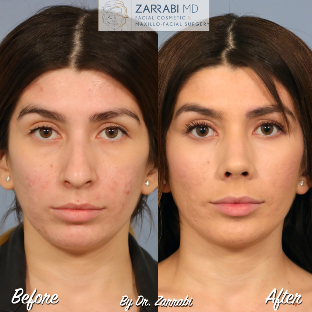 Closed Ultrasonic Rhinoplasty 1 10