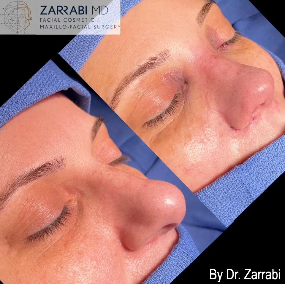 Closed Ultrasonic Rhinoplasty 1 11