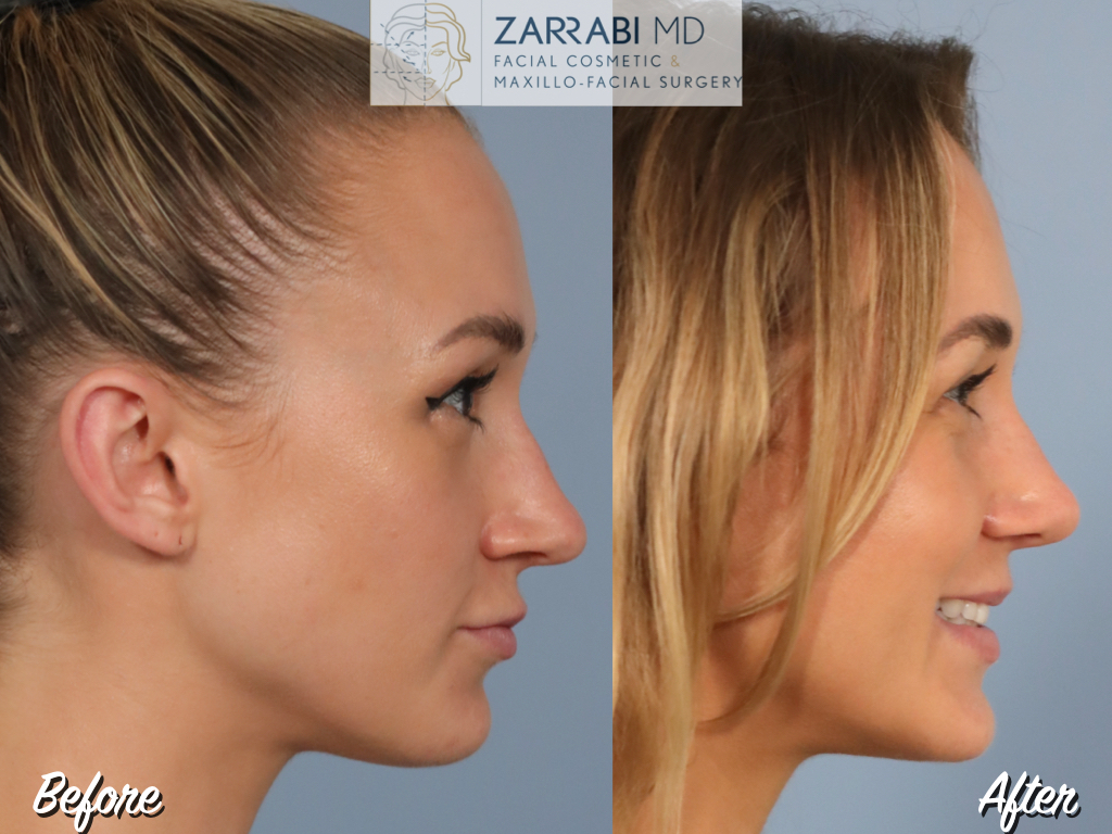 Closed Ultrasonic Rhinoplasty 1 12