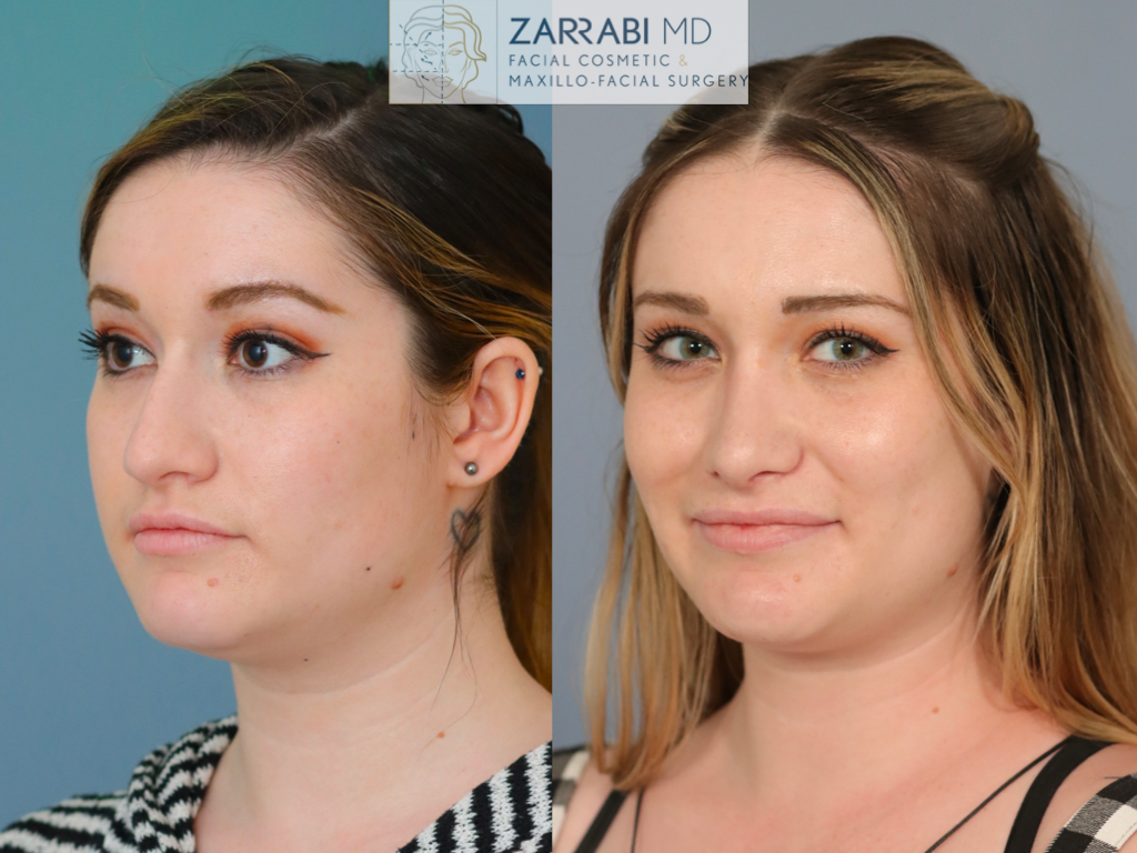 Closed Ultrasonic Rhinoplasty 1 13