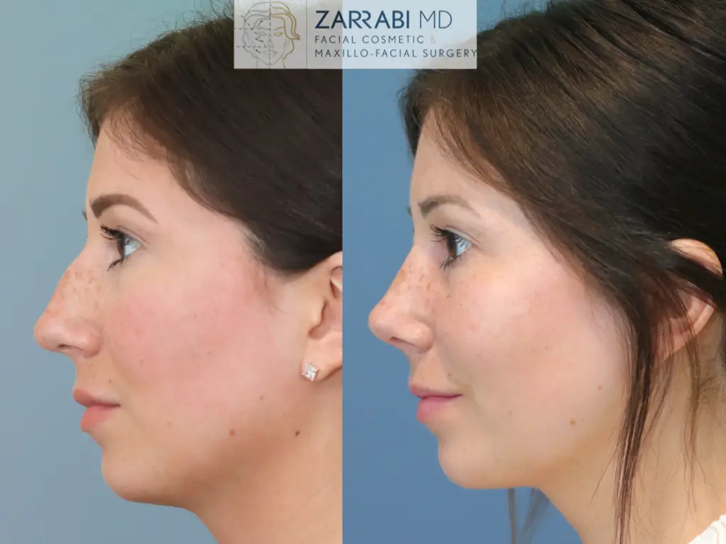 Closed-Ultrasonic-Rhinoplasty-1-14