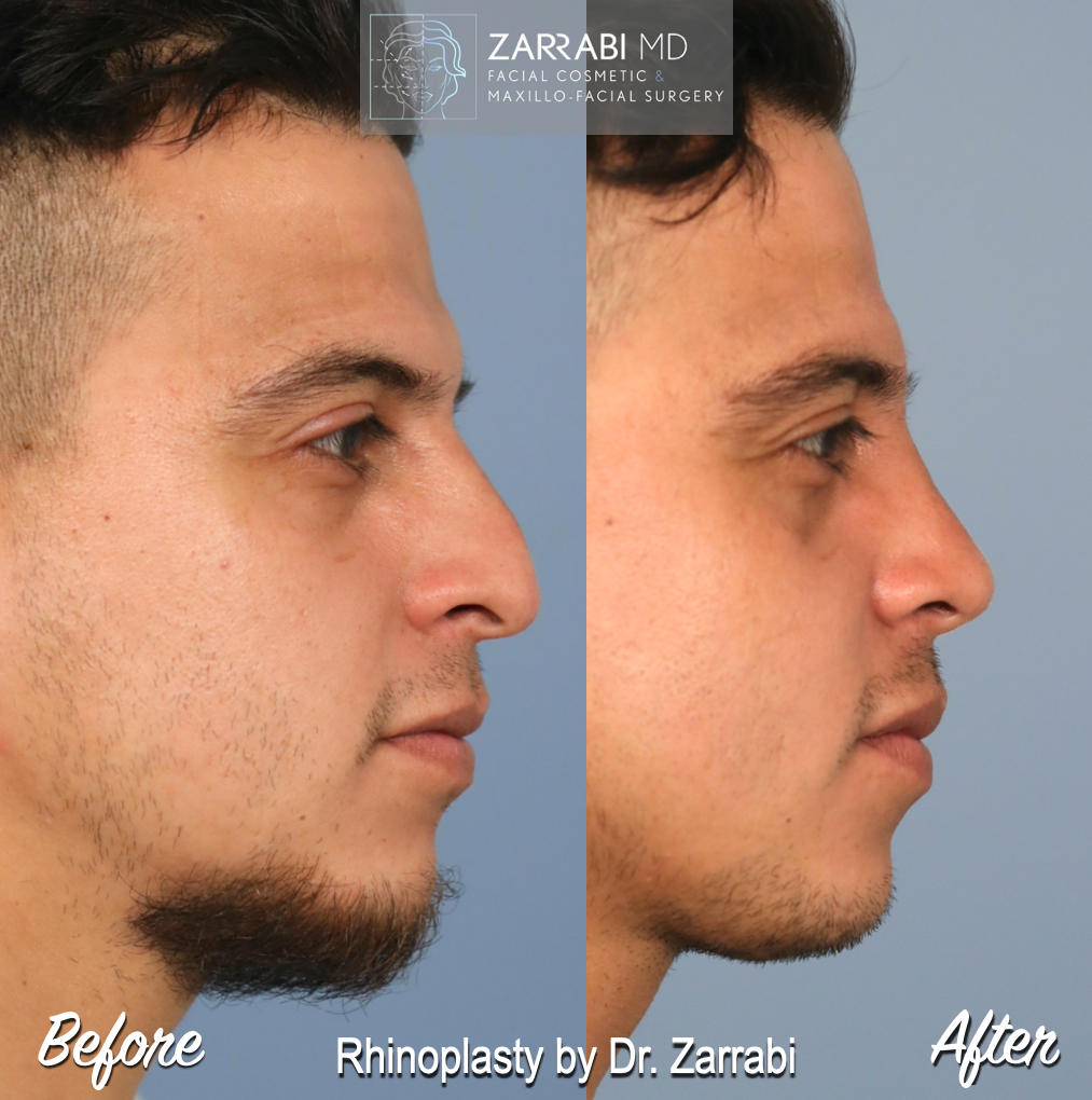 Closed Ultrasonic Rhinoplasty 1 2