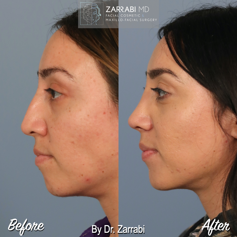 Closed Ultrasonic Rhinoplasty 1 3