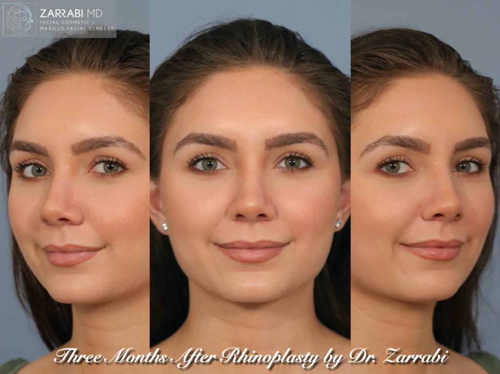 Closed Ultrasonic Rhinoplasty 1 4