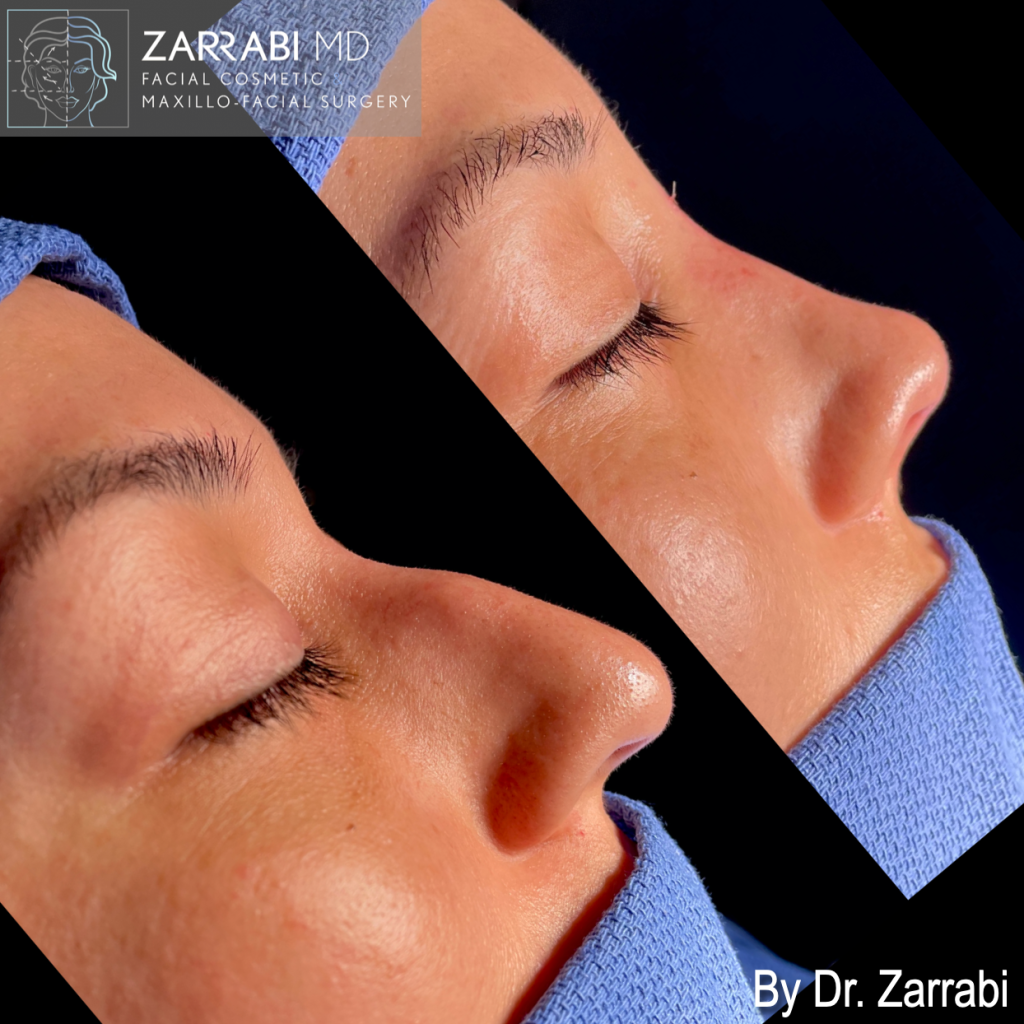 Closed Ultrasonic Rhinoplasty 1 5