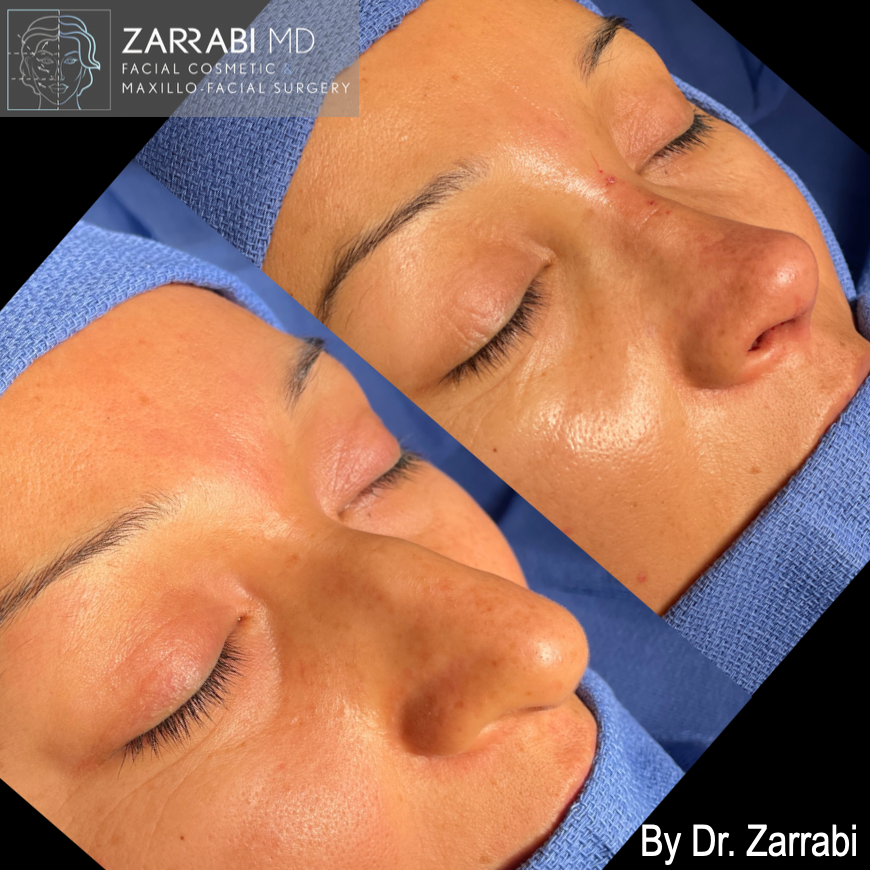 Closed Ultrasonic Rhinoplasty 1 7