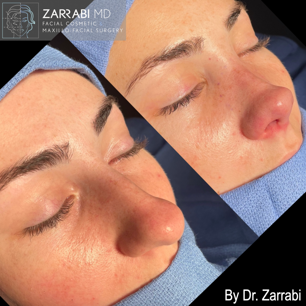 Closed Ultrasonic Rhinoplasty 1 8