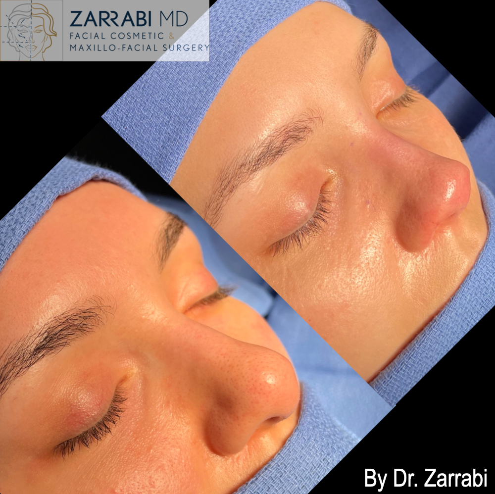Closed Ultrasonic Rhinoplasty 1 9
