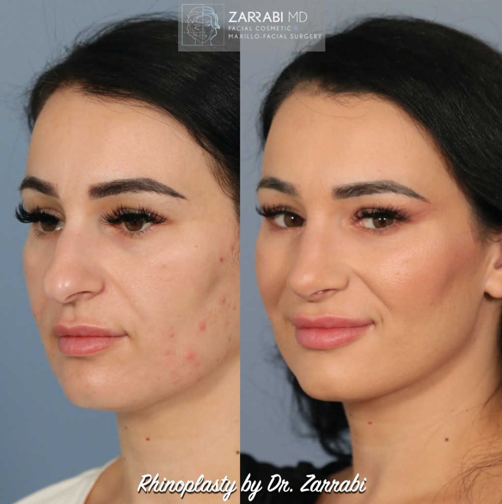 Closed Ultrasonic Rhinoplasty 2 1