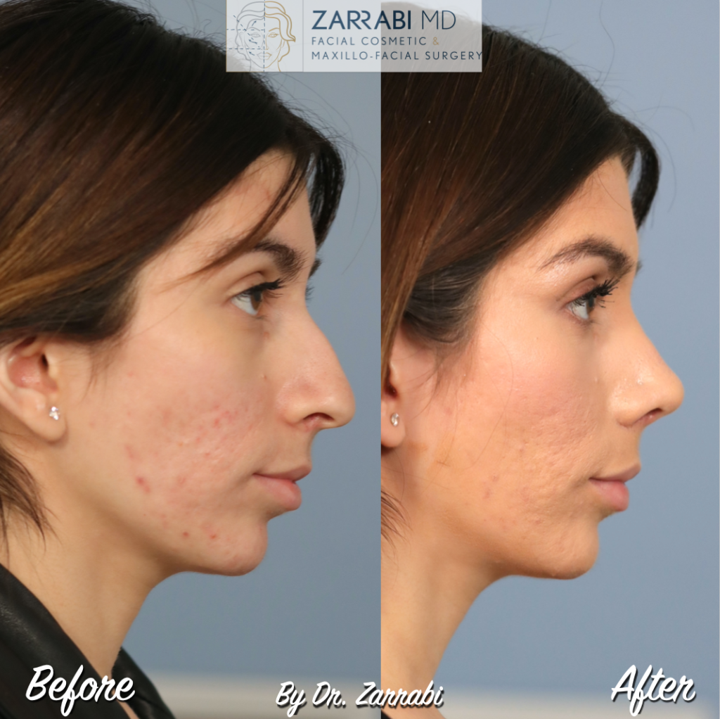 Closed Ultrasonic Rhinoplasty 2 10